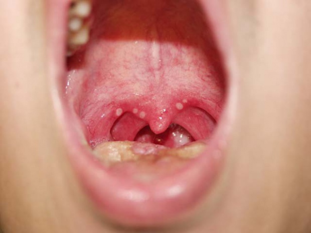 ヘルパンギーナ写真1